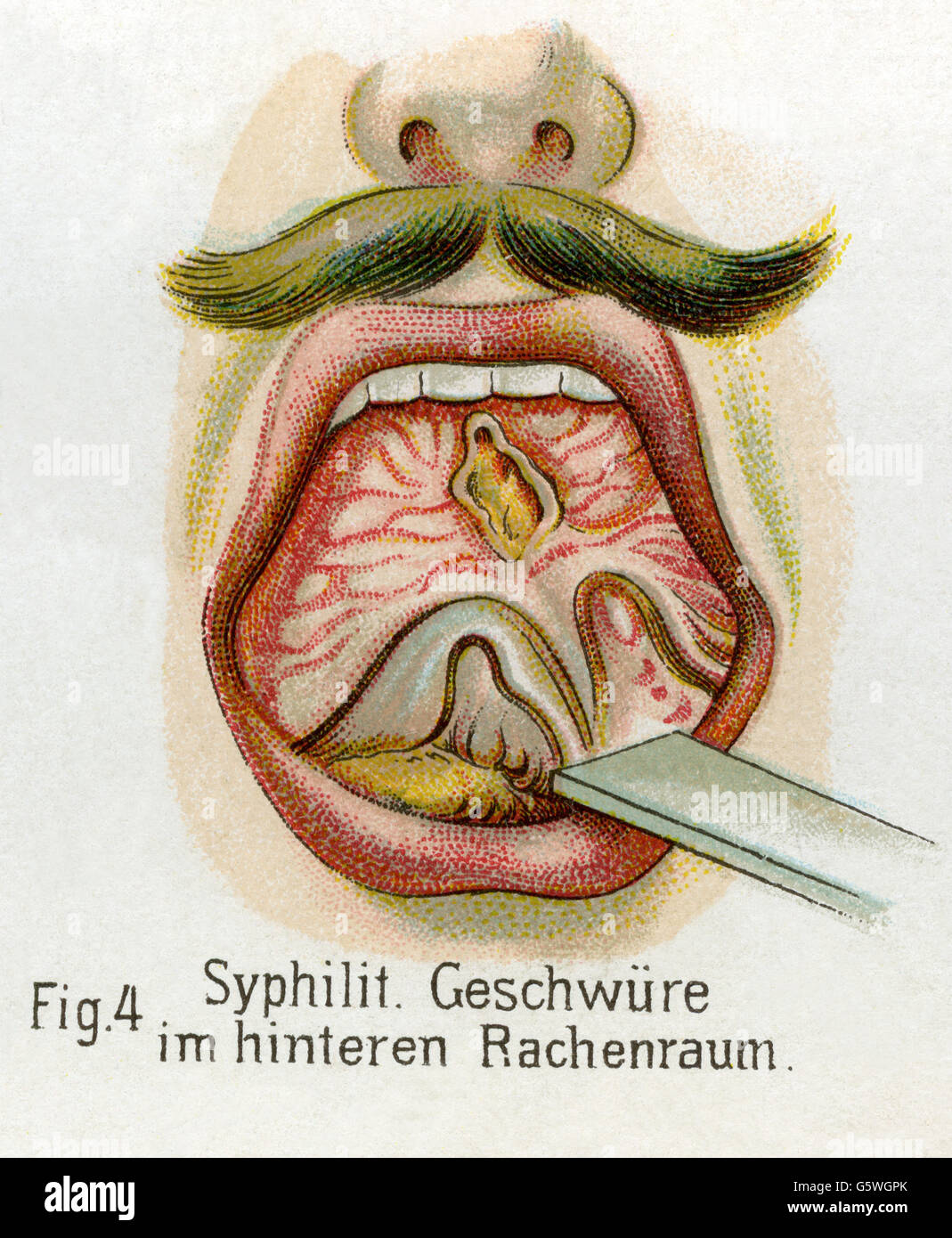 medicine, sexually transmitted diseases, syphilis, syphilitic blains in throat, from: Friedrich Eduard Bilz, New Naturopathic Treatment, Leipzig, Germany, 1902, Additional-Rights-Clearences-Not Available Stock Photo