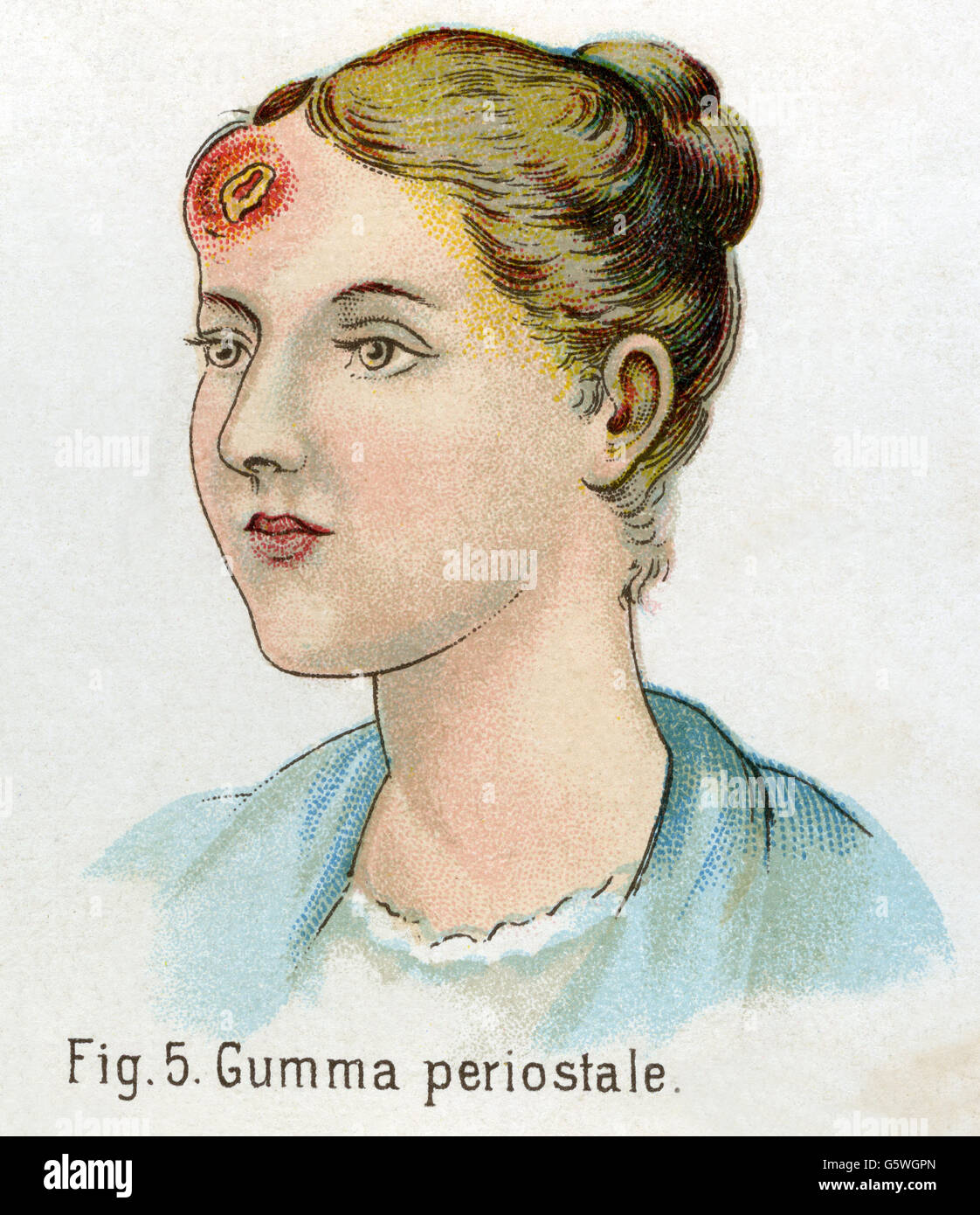medicine, sexually transmitted diseases, syphilis, Gumma periostale, from: Friedrich Eduard Bilz, New Naturopathic Treatment, Leipzig, Germany, 1902, Additional-Rights-Clearences-Not Available Stock Photo