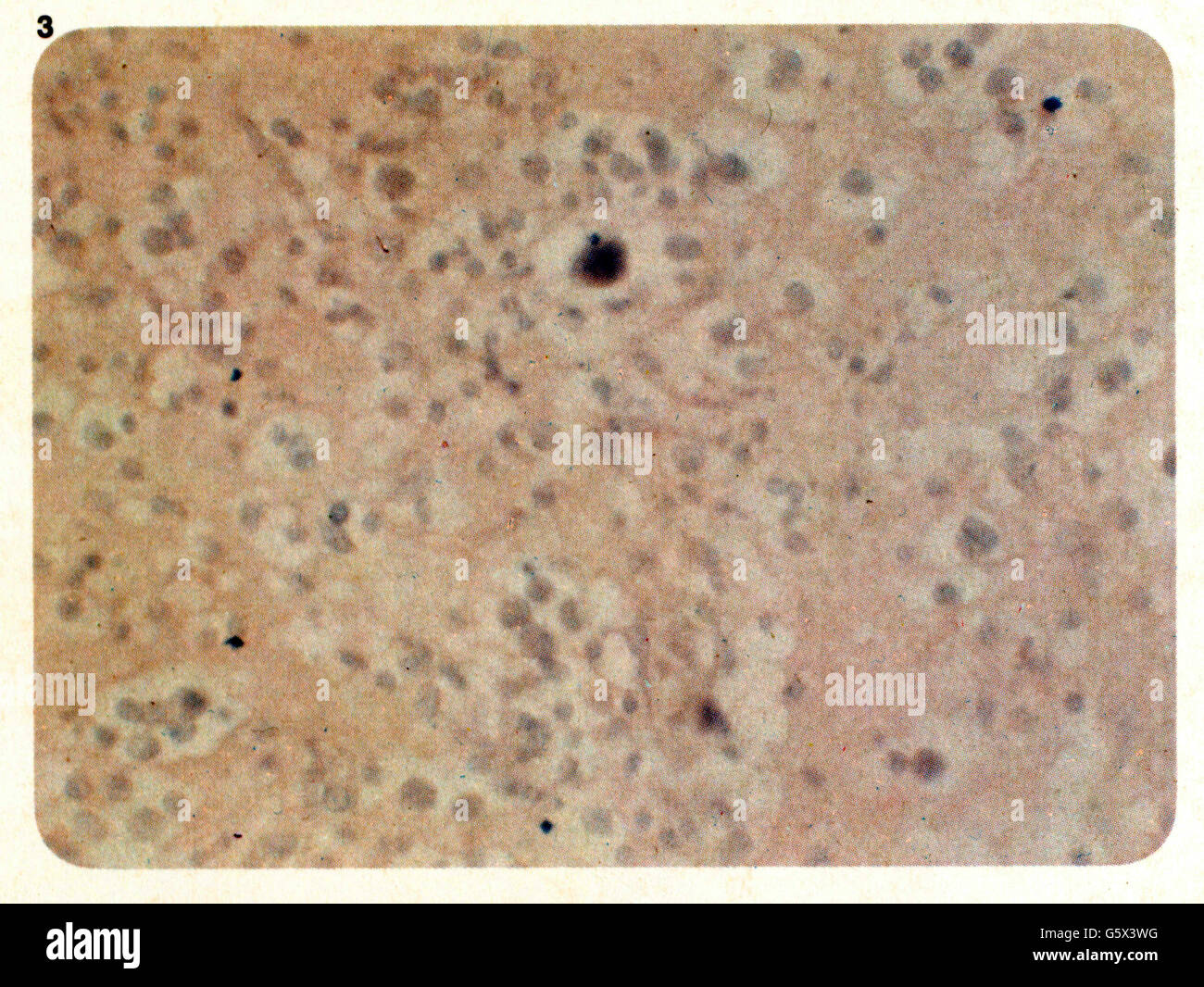 medicine, diseases, Blastomycosis, granulation tissue with shoot cells