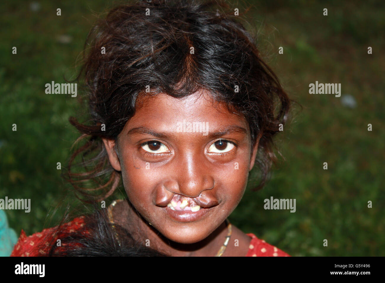 deformed kid A portrait of a poor Indian girl with deformed lips and mouth Stock Photo -  Alamy