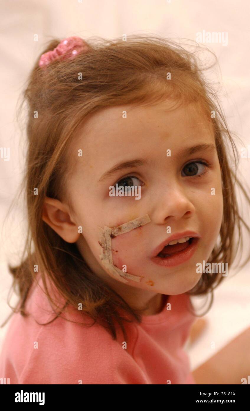Four-year-old Teoni Fletcher, who underwent emergency facial surgery after being attacked Friday 23th August, by a neighbour's bull mastiff. The dog bit away a section of her cheek as Teoni climbed up on the garden fence as she played outside her home, in Exeter. Stock Photo