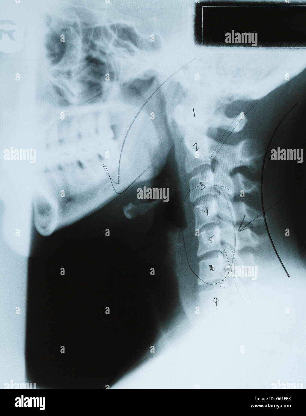 Side View X Ray of Human Neck and Head With Doctor Notes. Stock Photo