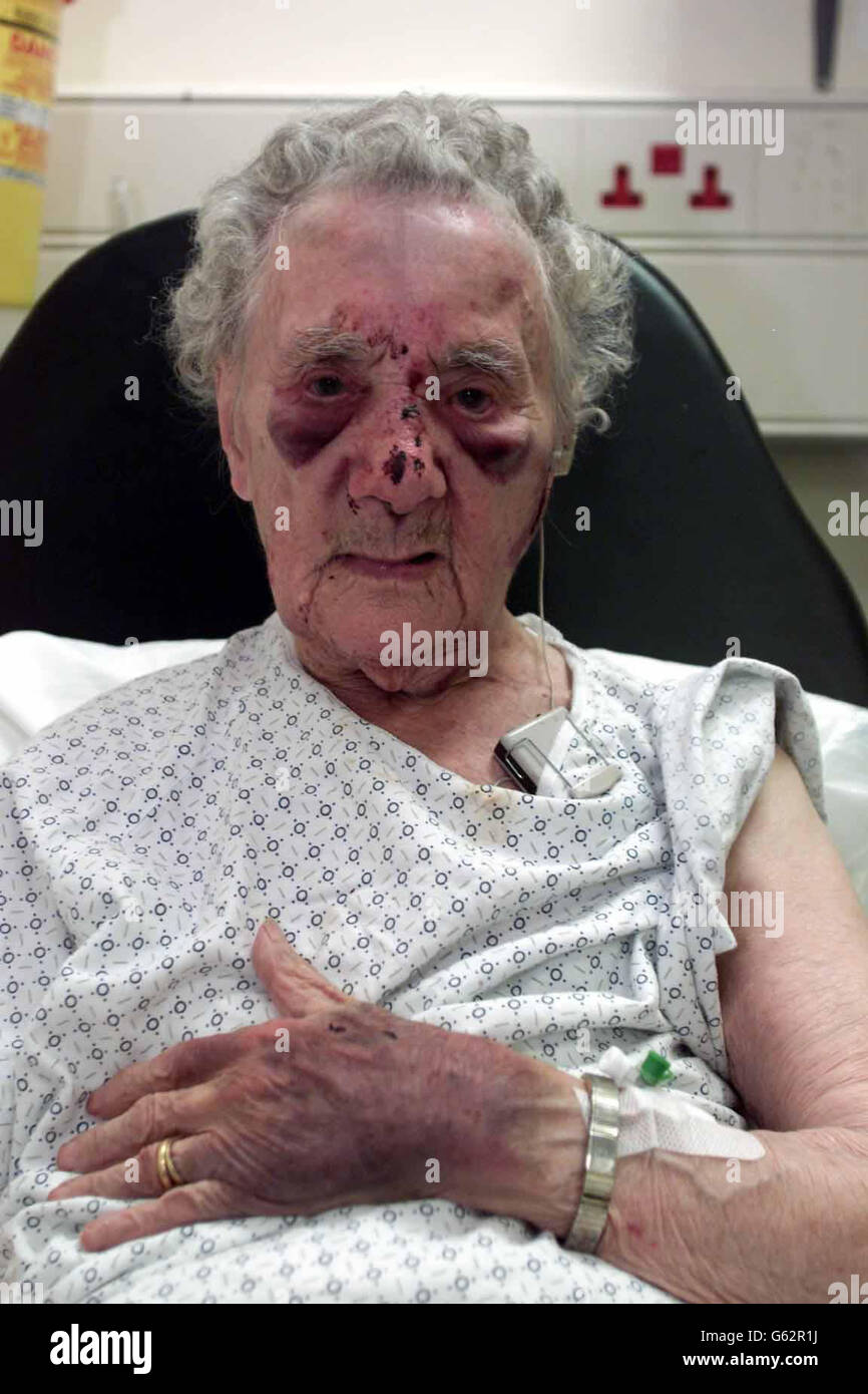 : Police in London have released this photograph showing the shocking injuries inflicted on 95-year-old Doris Marr, from East Ham, east London, who was repeatedly punched by an intruder while she lay in bed. * A man, thought to be in his twenties, punched Mrs Marr in the face several times after she asked him what he was doing when she found him searching through her wardrobe. SHe is now recovering in Newham General Hospital. Stock Photo