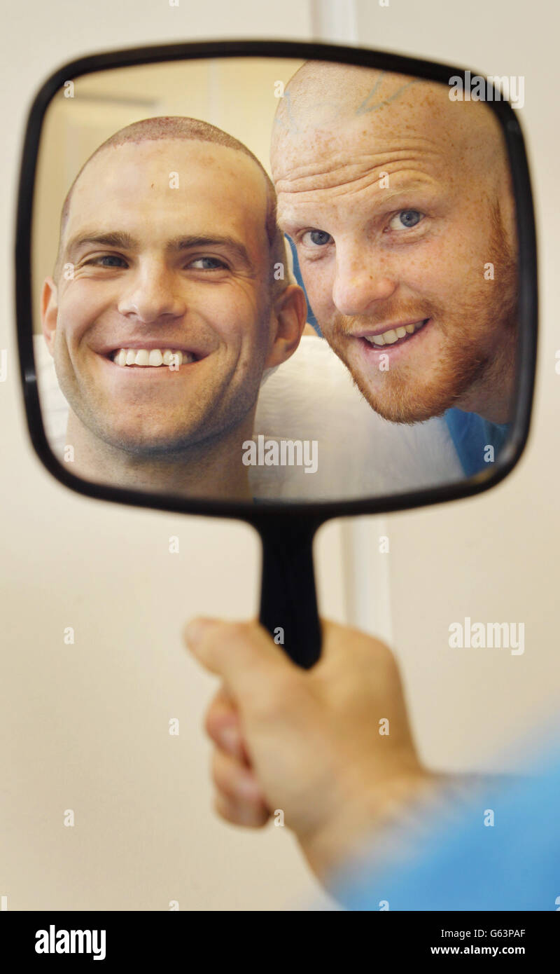 Brothers Barry Cowan (right) and Brian Cowan, after undergoing a FUE