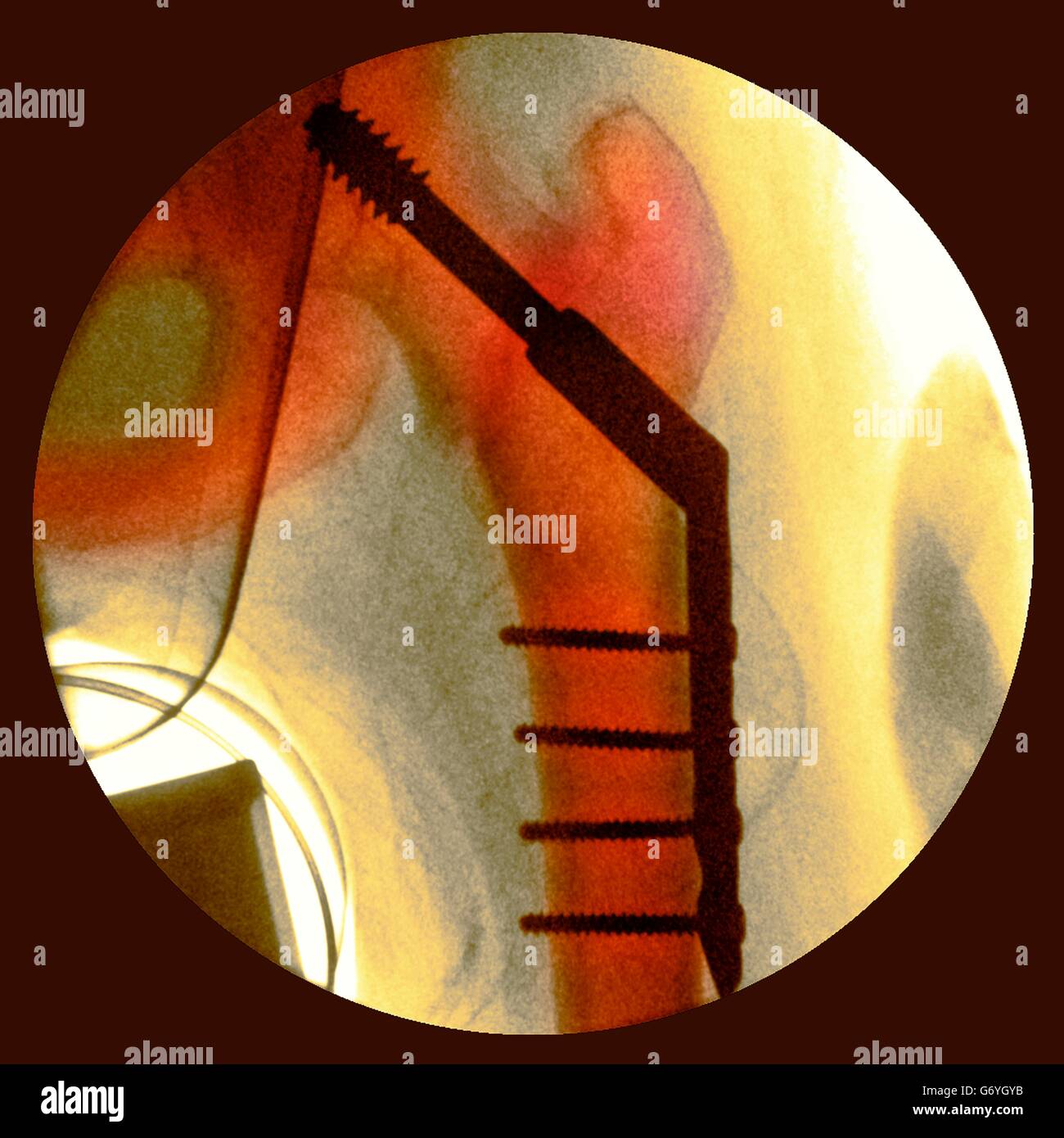 Pinned fractured hip. Coloured X-ray of a section through the hip of a 91-year-old female patient with a fracture affecting the head of the femur (thigh bone, vertical), showing plates and pins (black) being used to fix the broken bone in place during hea Stock Photo