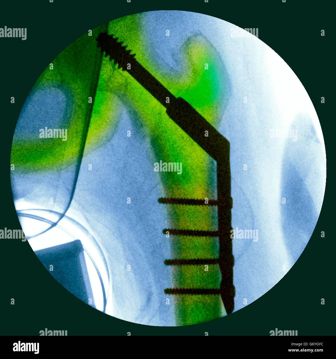 Pinned fractured hip. Coloured X-ray of a section through the hip of a 91-year-old female patient with a fracture affecting the head of the femur (thigh bone, vertical), showing plates and pins (black) being used to fix the broken bone in place during hea Stock Photo