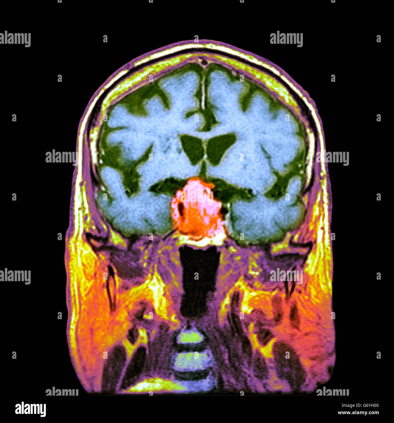 Pituitary tumour. Coloured computed tomography (CT) scan of a section through the brain of an 84-year-old male patient with a tumour (round, centre) affecting the pituitary gland. Pituitary tumours are usually adenomas - benign (non-cancerous) tumours ari Stock Photo