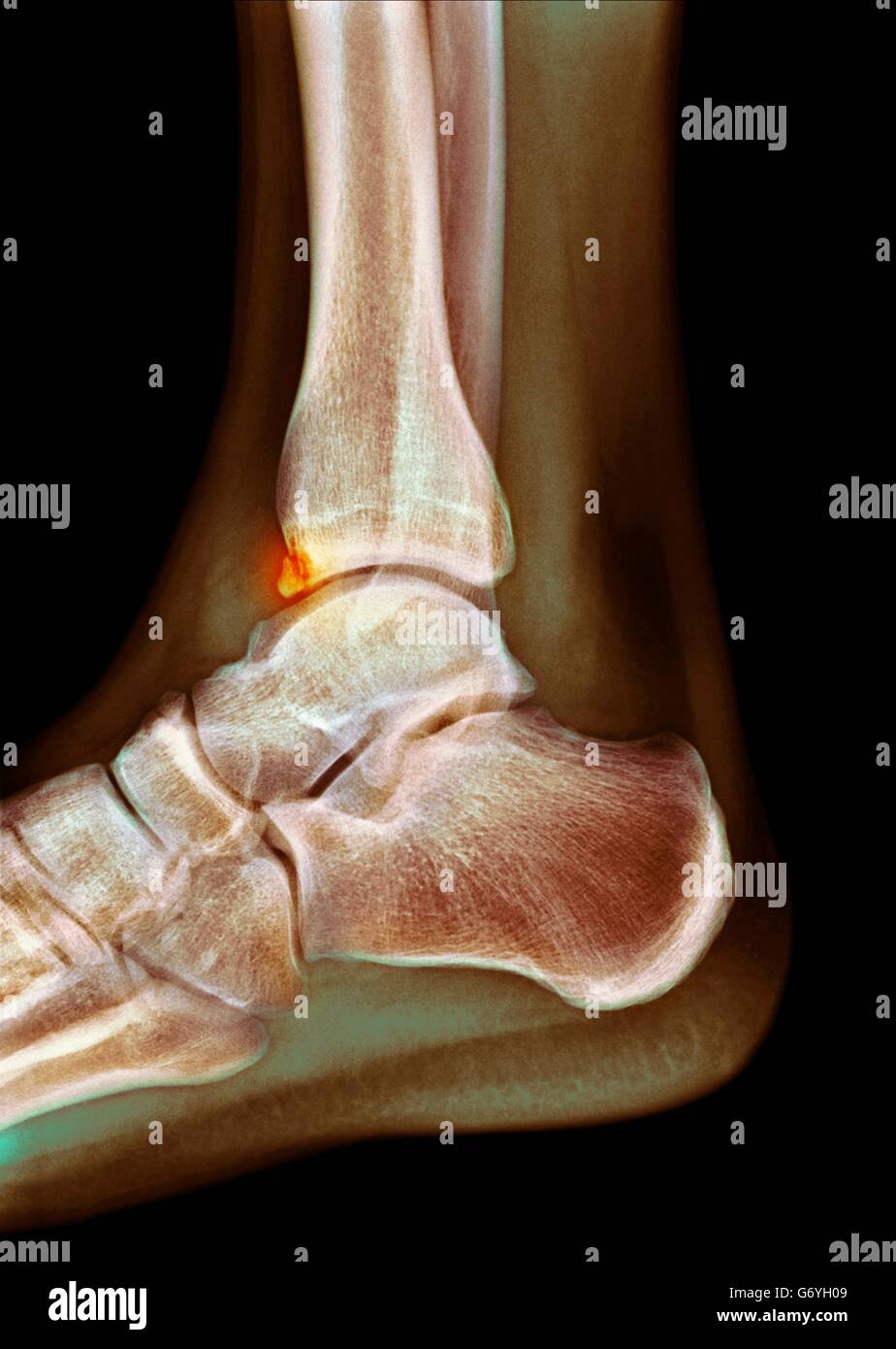 calcaneal spur xray