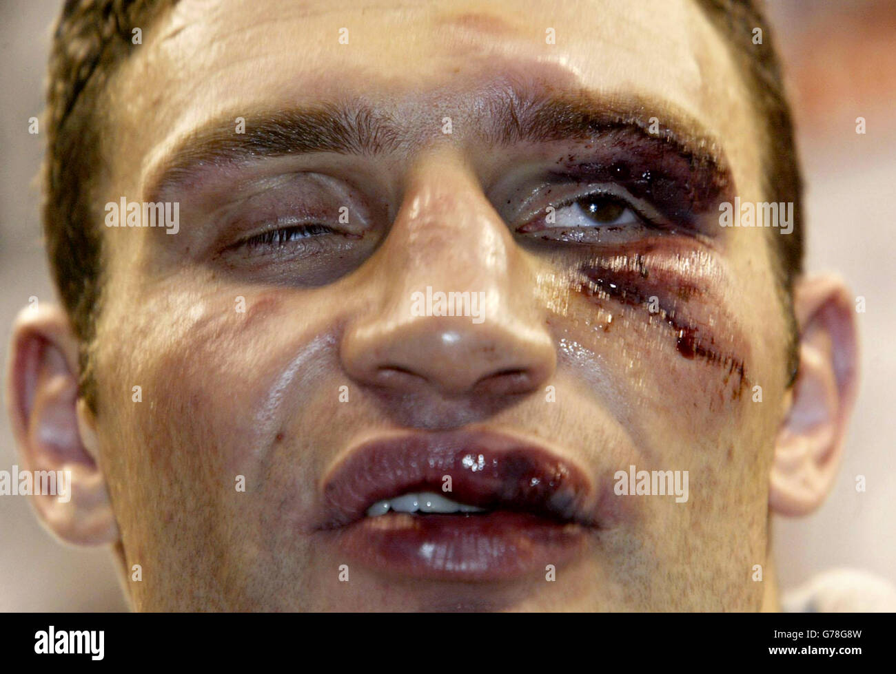 the-badly-cut-face-of-the-defeated-vitali-klitschko-at-the-post-fight-G78G8W.jpg