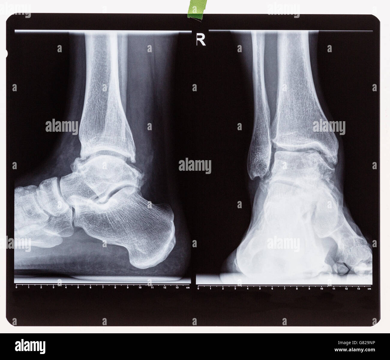 Xray of the right foot ankle joint Stock Photo Alamy