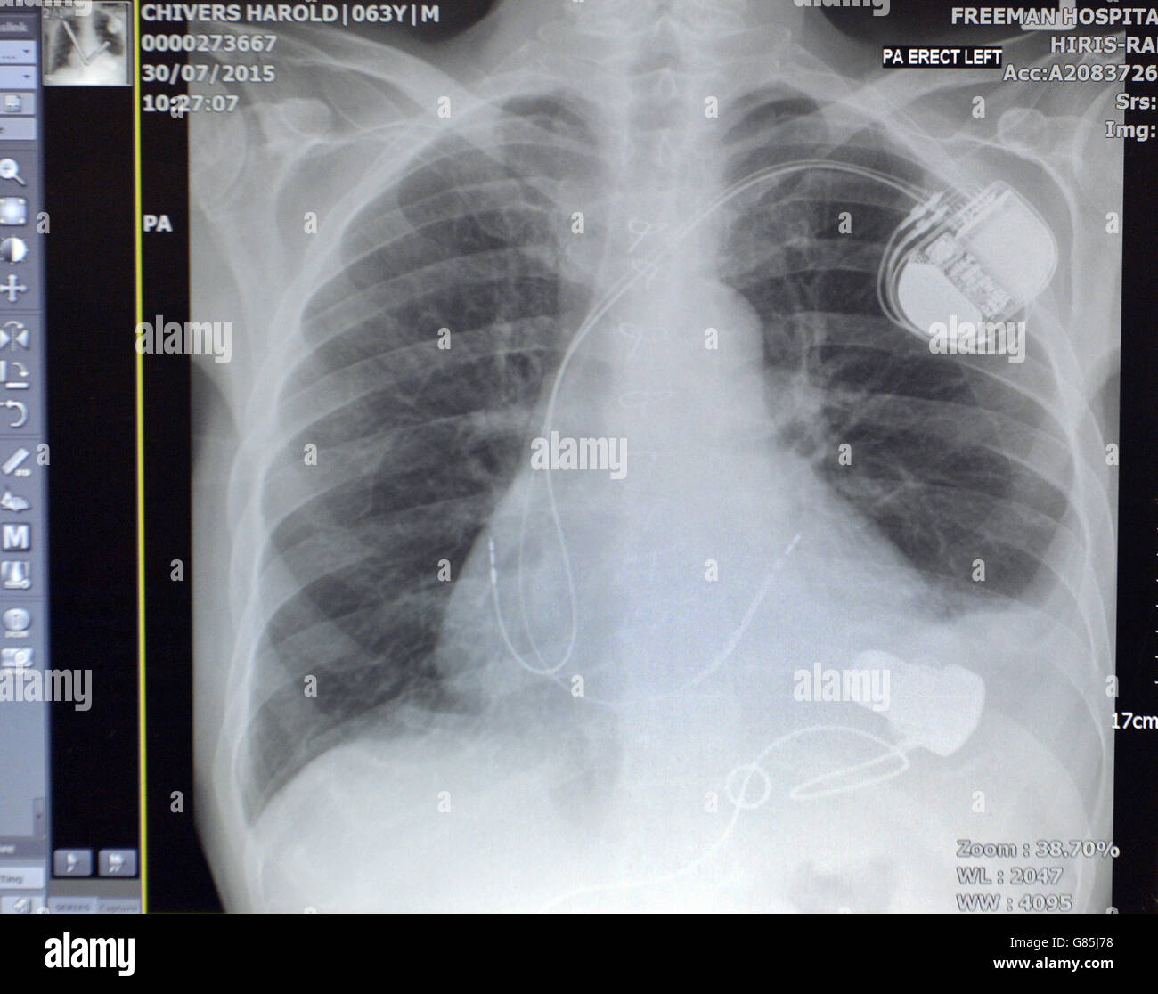 Patient has pioneering heart pump implant Stock Photo