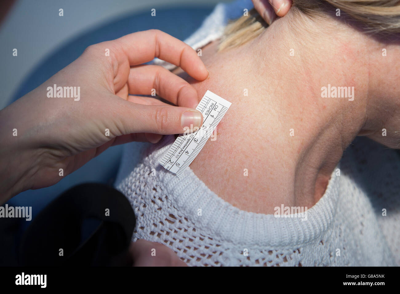 Dermatologist measuring Melanoma during Skin Cancer Test Stock Photo