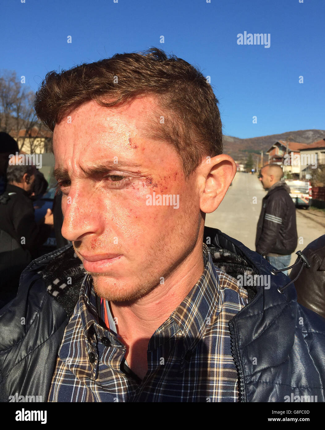 Afghan refugee Weligol Alimjan, 20, in Dimitrovgrad, Serbia, who alleged he was hit by Bulgarian police, as consistent reports of the police abusing refugees have been uncovered by Oxfam. Stock Photo