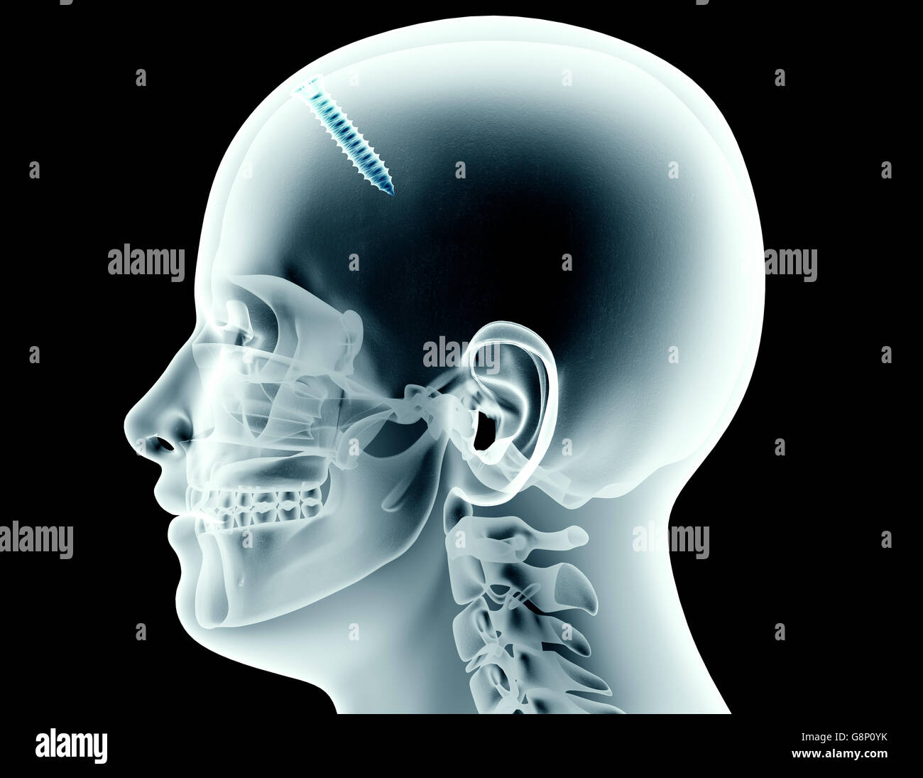 x-ray image of a skull with a screw,3d illustration Stock Photo