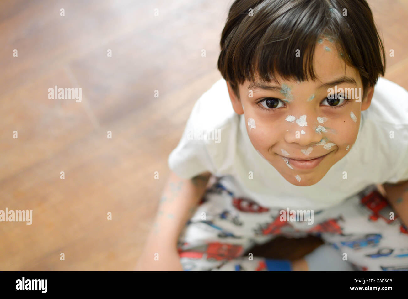 Young kid at home sick with chicken pox, white and green antiseptic cream applied to the rash Stock Photo