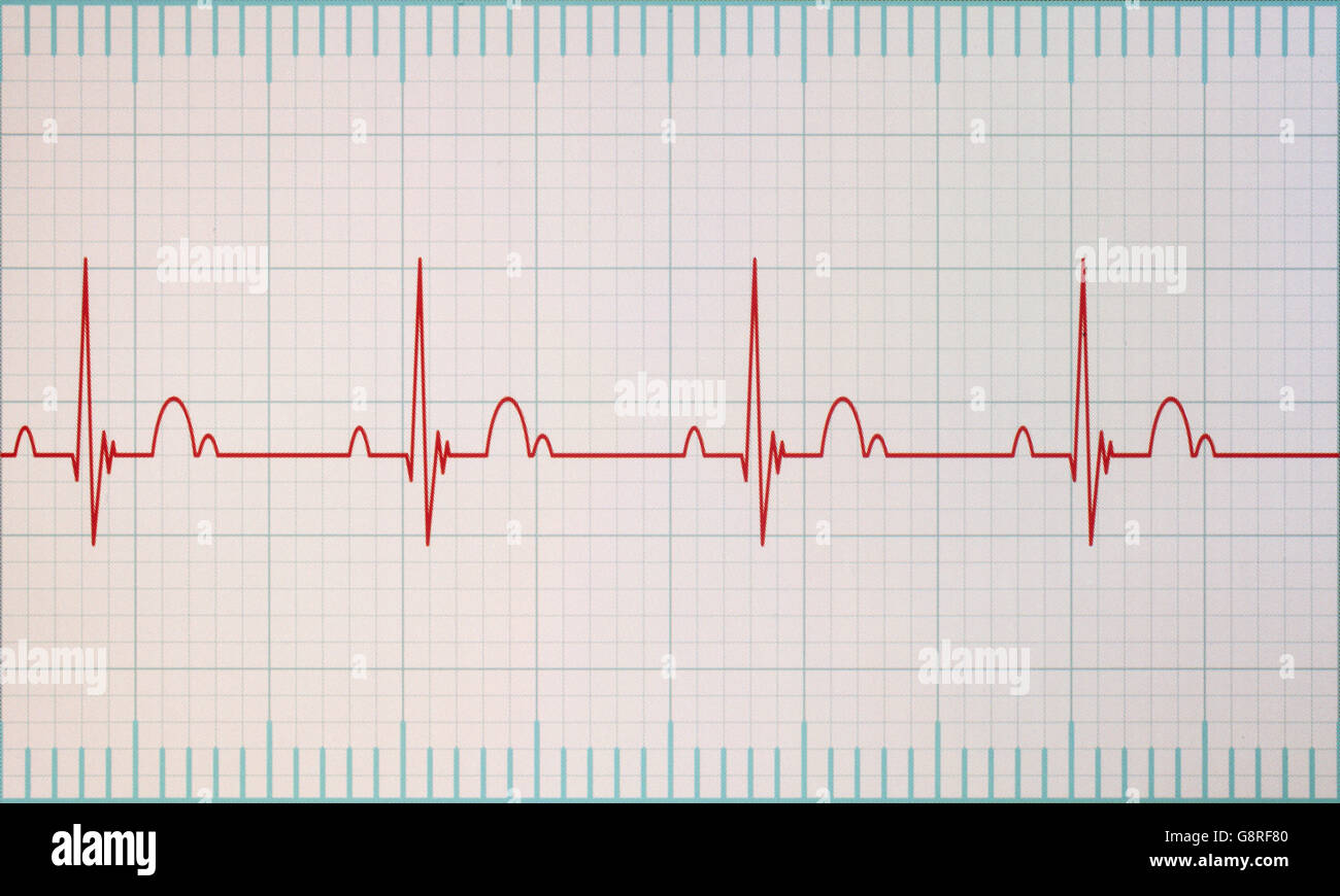 Flatline blip on a medical heart monitor ECG / EKG (electrocardiogram) with white background