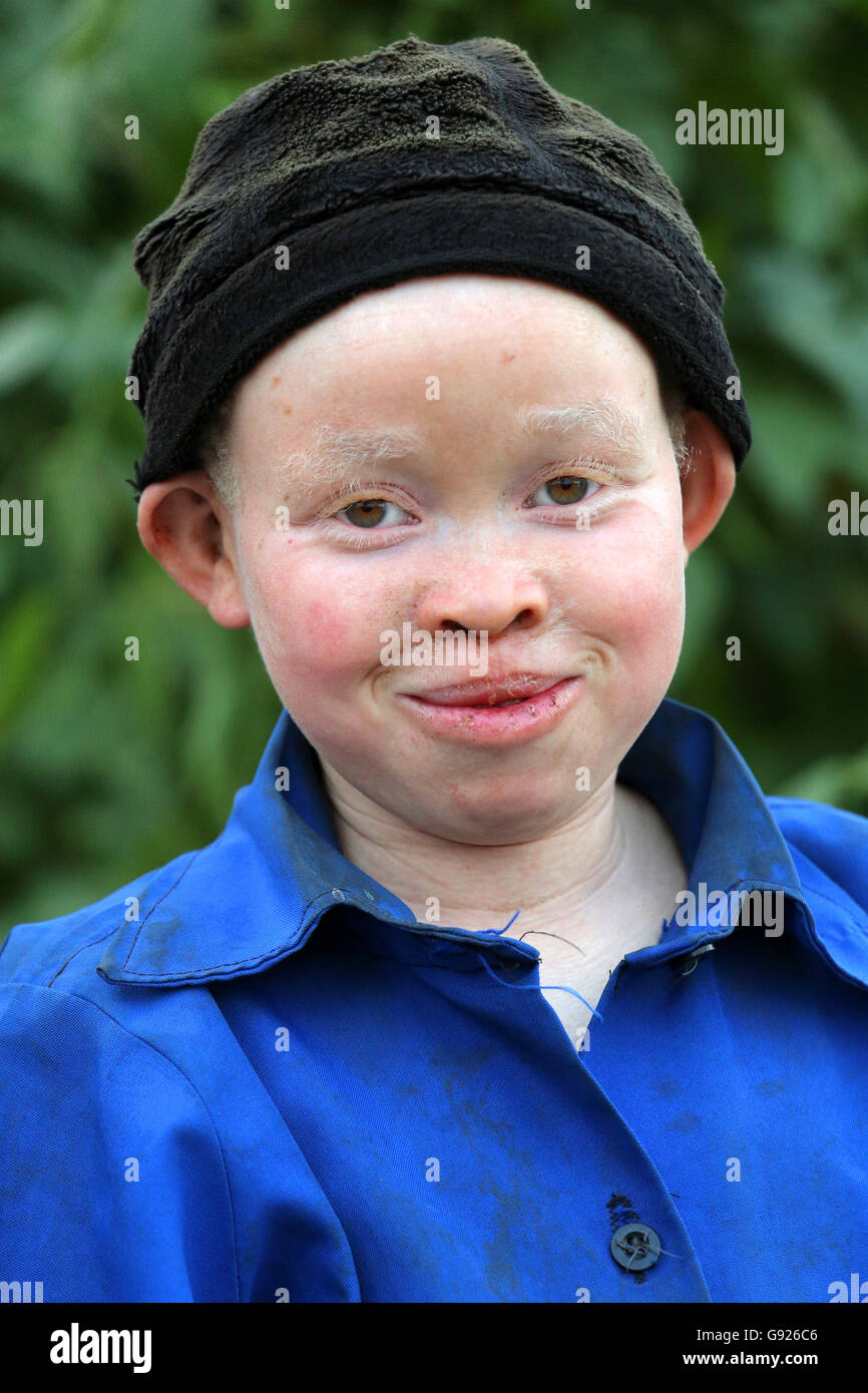 Albino girl (12 years) in a village in Rwanda, Africa Stock Photo