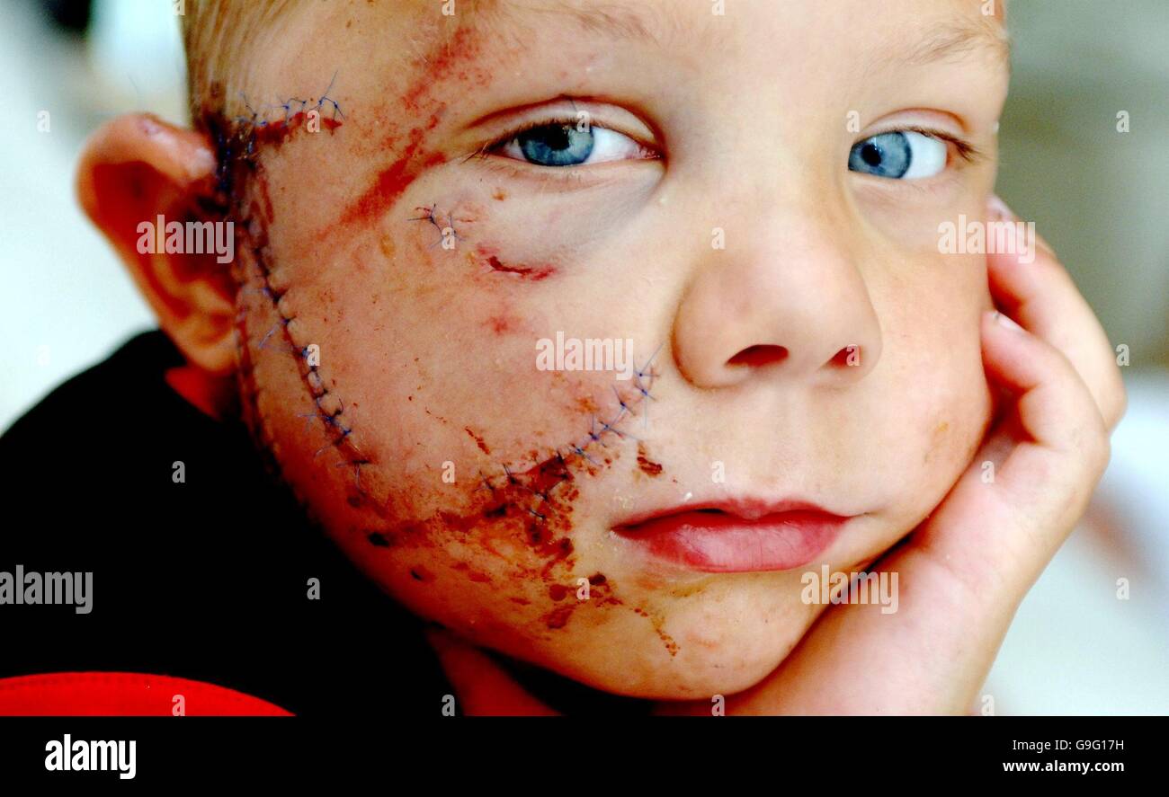 Four-year-old George Brown from Huntingdon, Cambridgeshire, recovers at home today after being mauled by a dog. Stock Photo