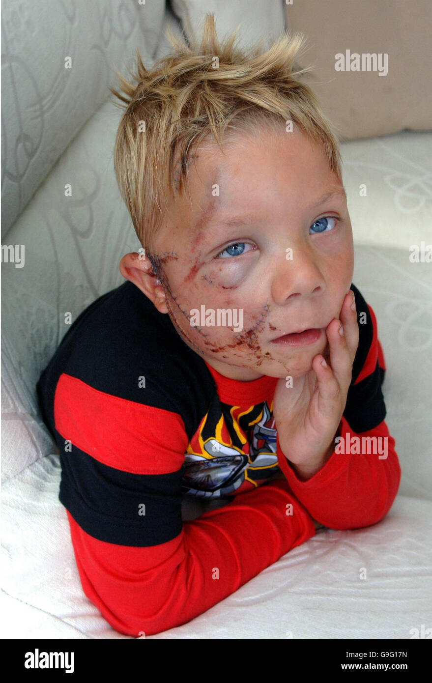 Four-year-old George Brown from Huntingdon, Cambridgeshire, recovers at home today after being mauled by a dog. Stock Photo