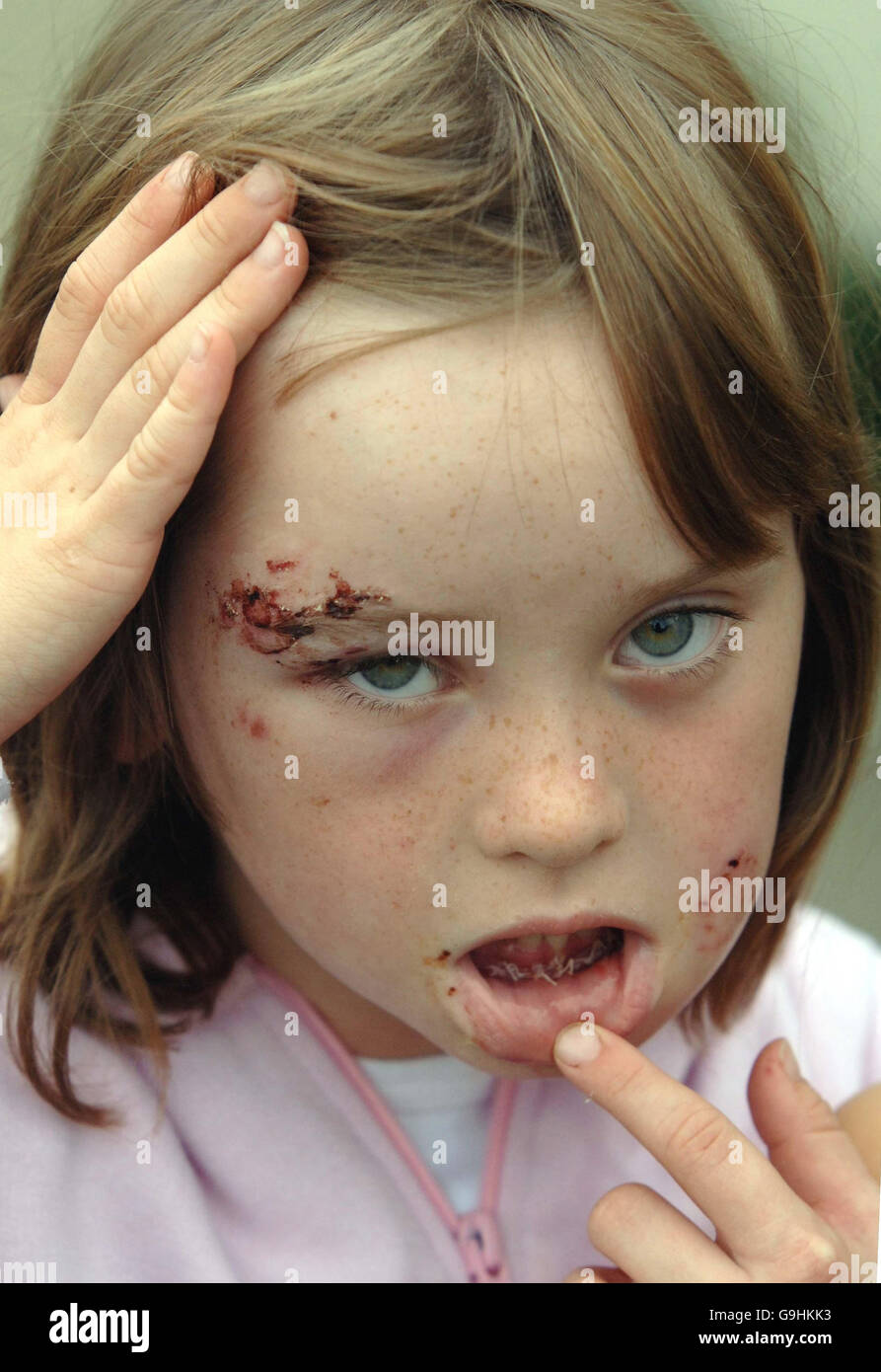 Hannah Russell, aged seven, from Cam, Gloucestershire, shows the injuries to her face and the inside of her mouth after an attack by a dog. Stock Photo