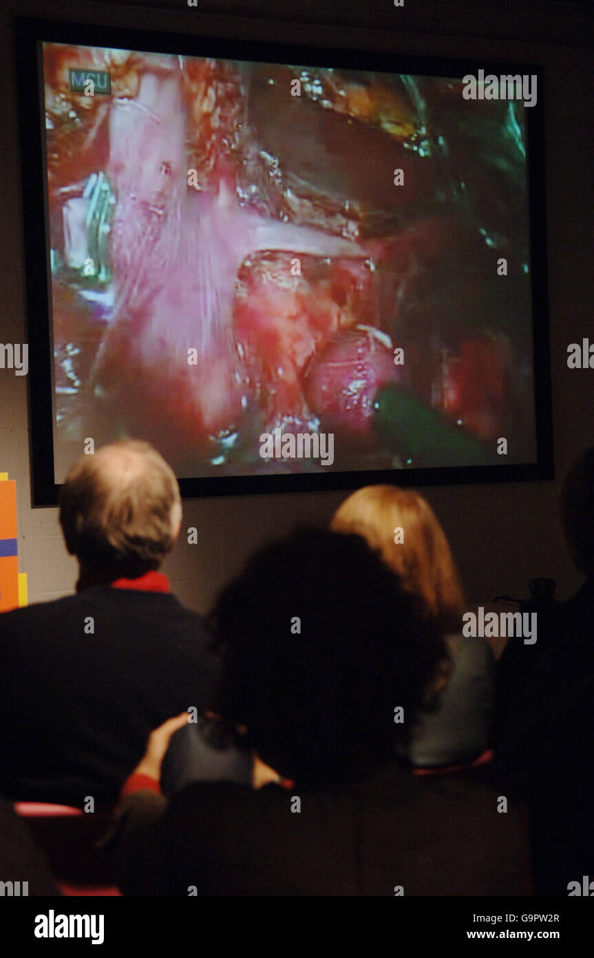 Visitors to the Science Museum's adult-only Dana Centre in London watch the first live kidney transplant broadcast from the Saint Barnabas Medical Centre in New Jersey in the United States. Stock Photo