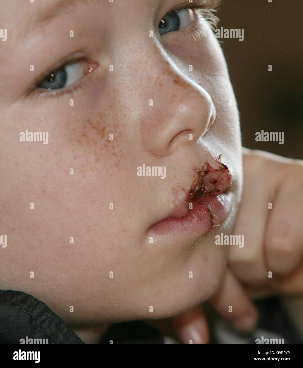 John Henderson, aged nine, from North Shields, who lost his top lip after family pet Simba, a Staffordshire bull terrier cross, attacked him as he ate a biscuit. Stock Photo