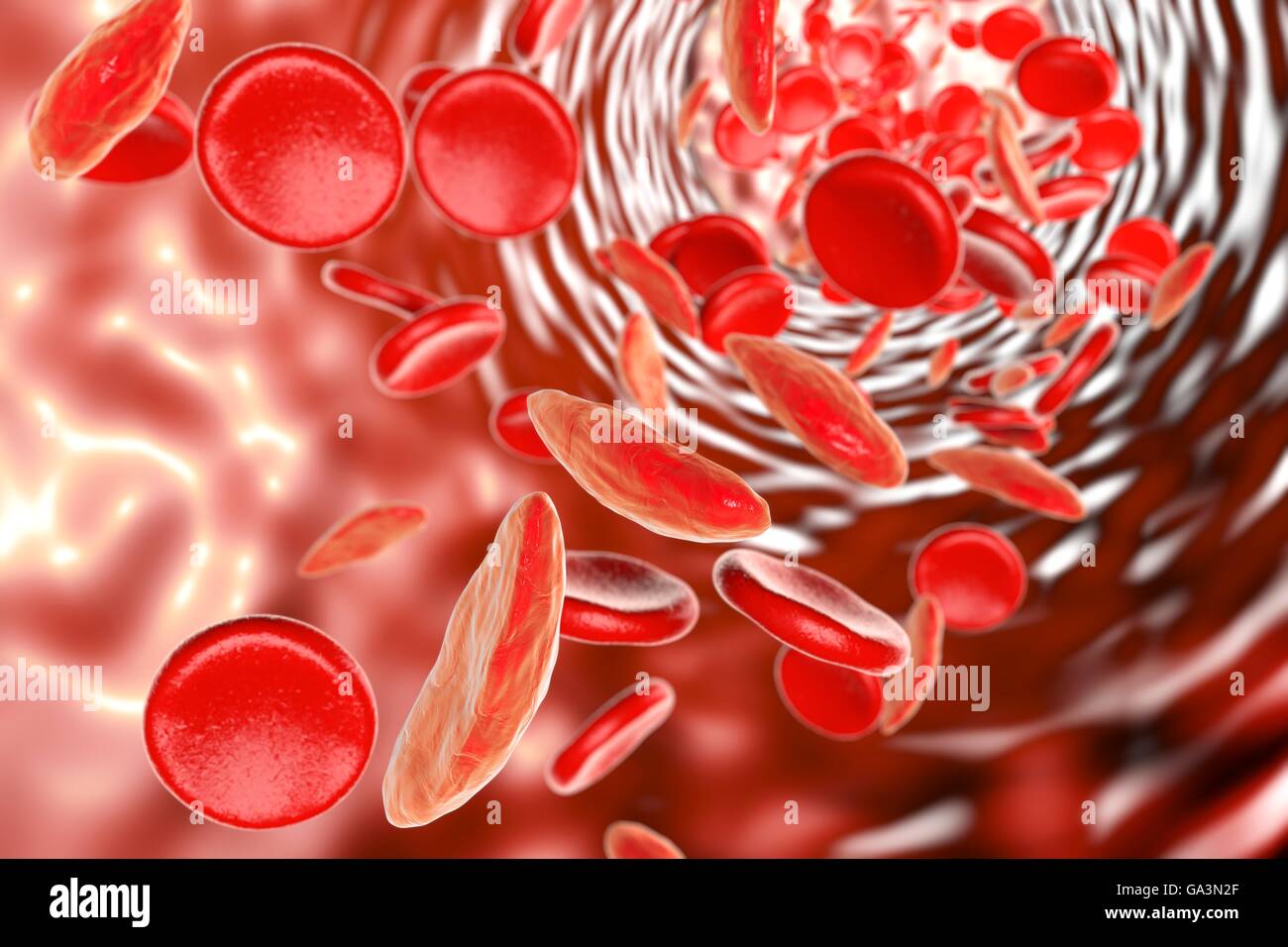 Sickle cell anaemia. Artwork showing normal red blood cells (round), and red blood cells affected by sickle cell anaemia (crescent shaped). This is a disease in which the red blood cells contain an abnormal form of haemoglobin (blood's oxygen-carrying pigment) that causes the blood cells to become sickle-shaped, rather than round. Sickle cells cannot move through small blood vessels as easily as normal cells and so can cause blockages (right). This prevents oxygen from reaching the tissues, causes severe pain and organ damage. Stock Photo