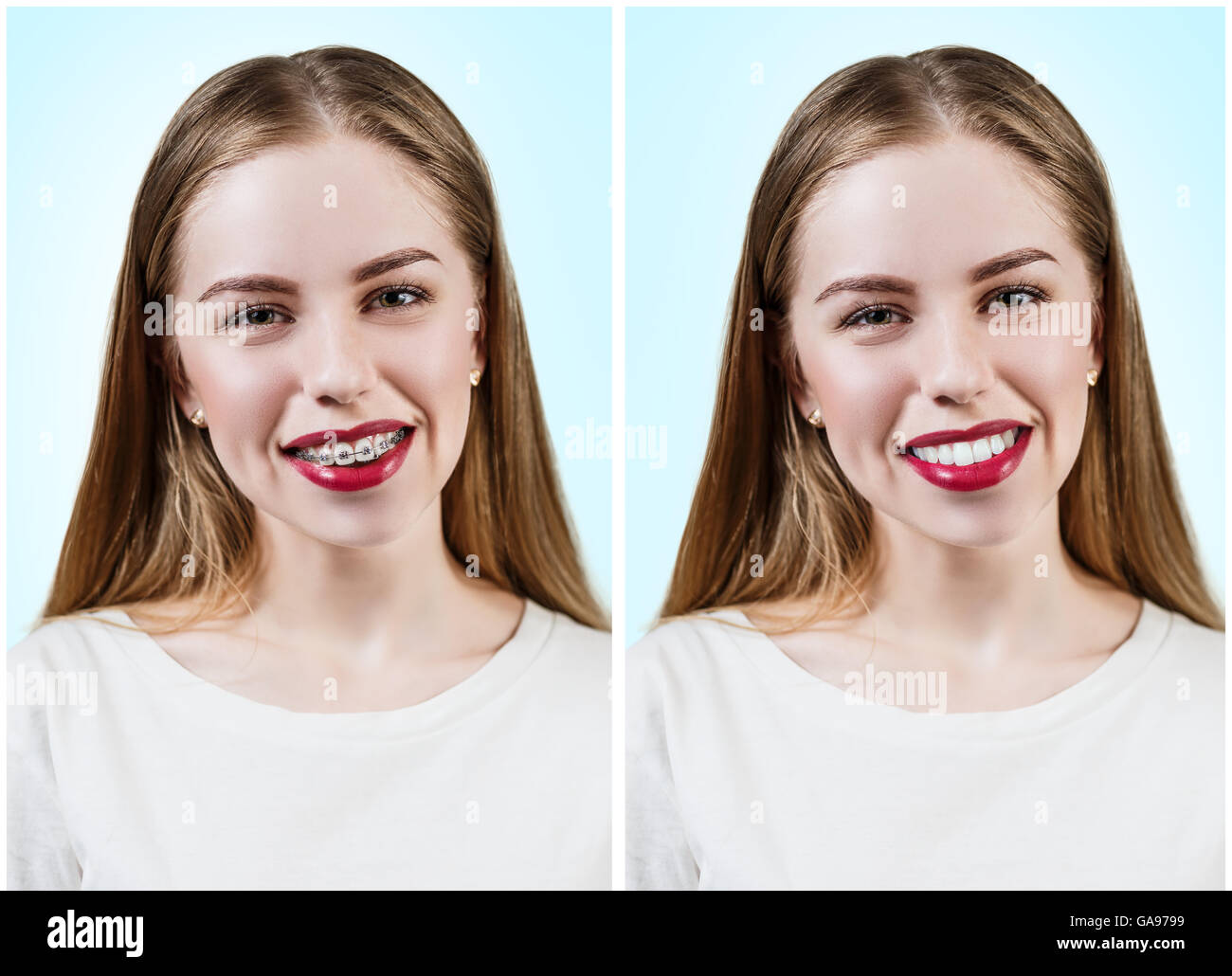 Young woman with perfect teeth before and after braces over blue