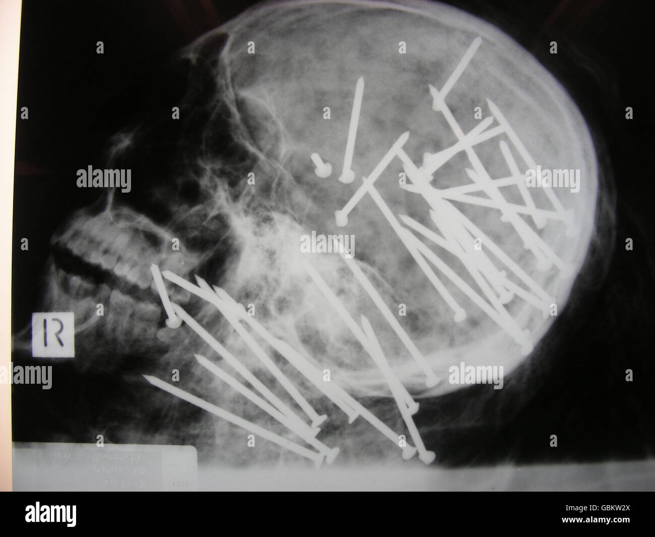 Xray image of man shot with nailgun Stock Photo Alamy