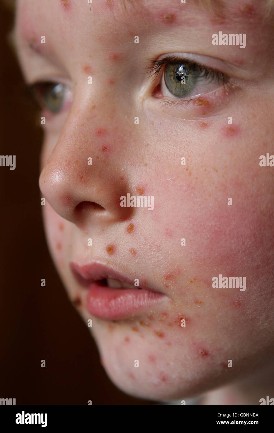STOCK. A child with chicken pox Stock Photo - Alamy