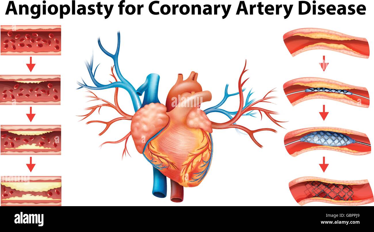 Diagram showing angioplasty for coronary artery disease illustration Stock Vector