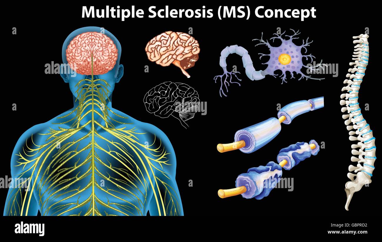 Diagram showing multiple sclerosis concept illustration Stock Vector