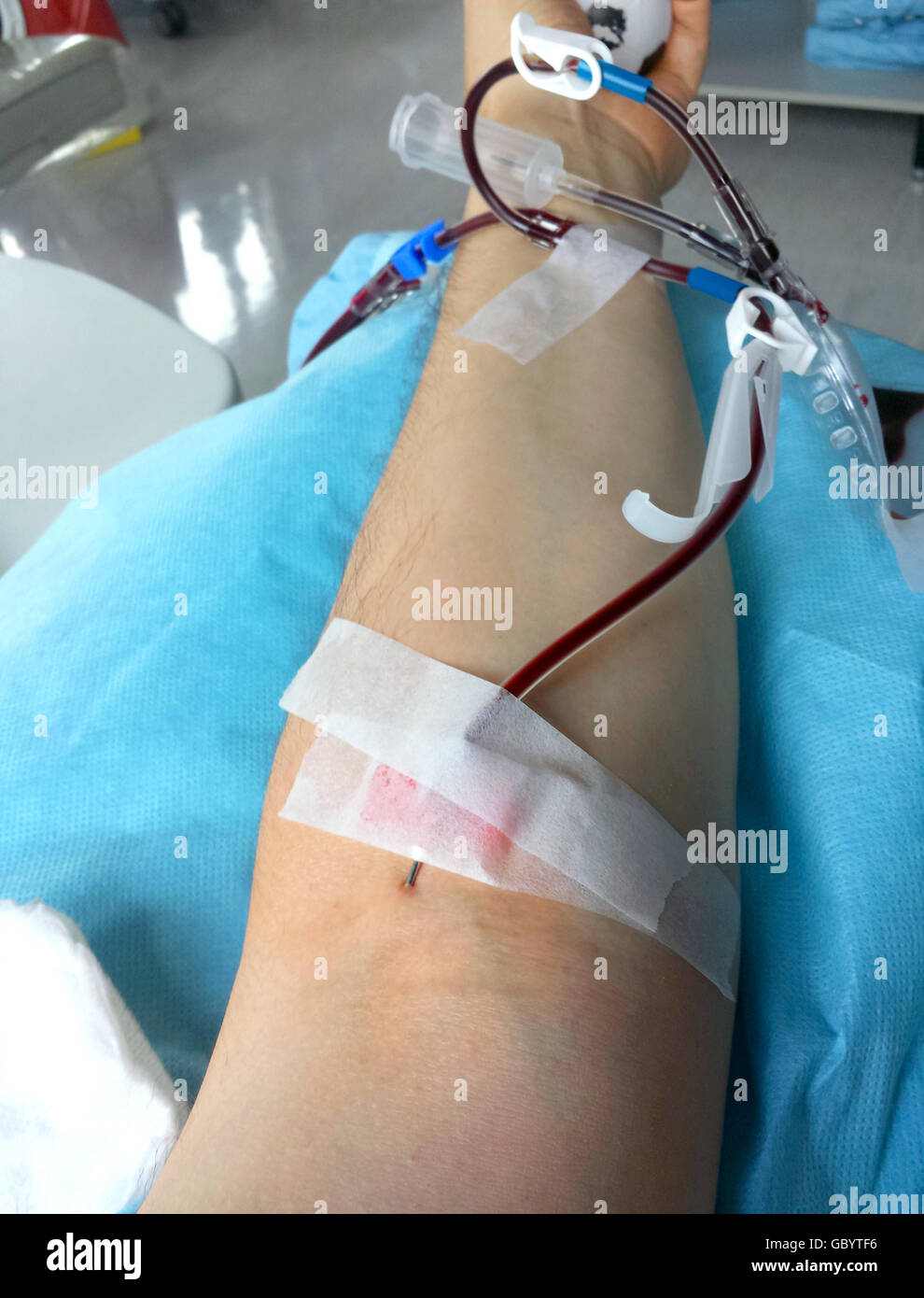 arm of the volunteer when donating blood in hospital Stock Photo