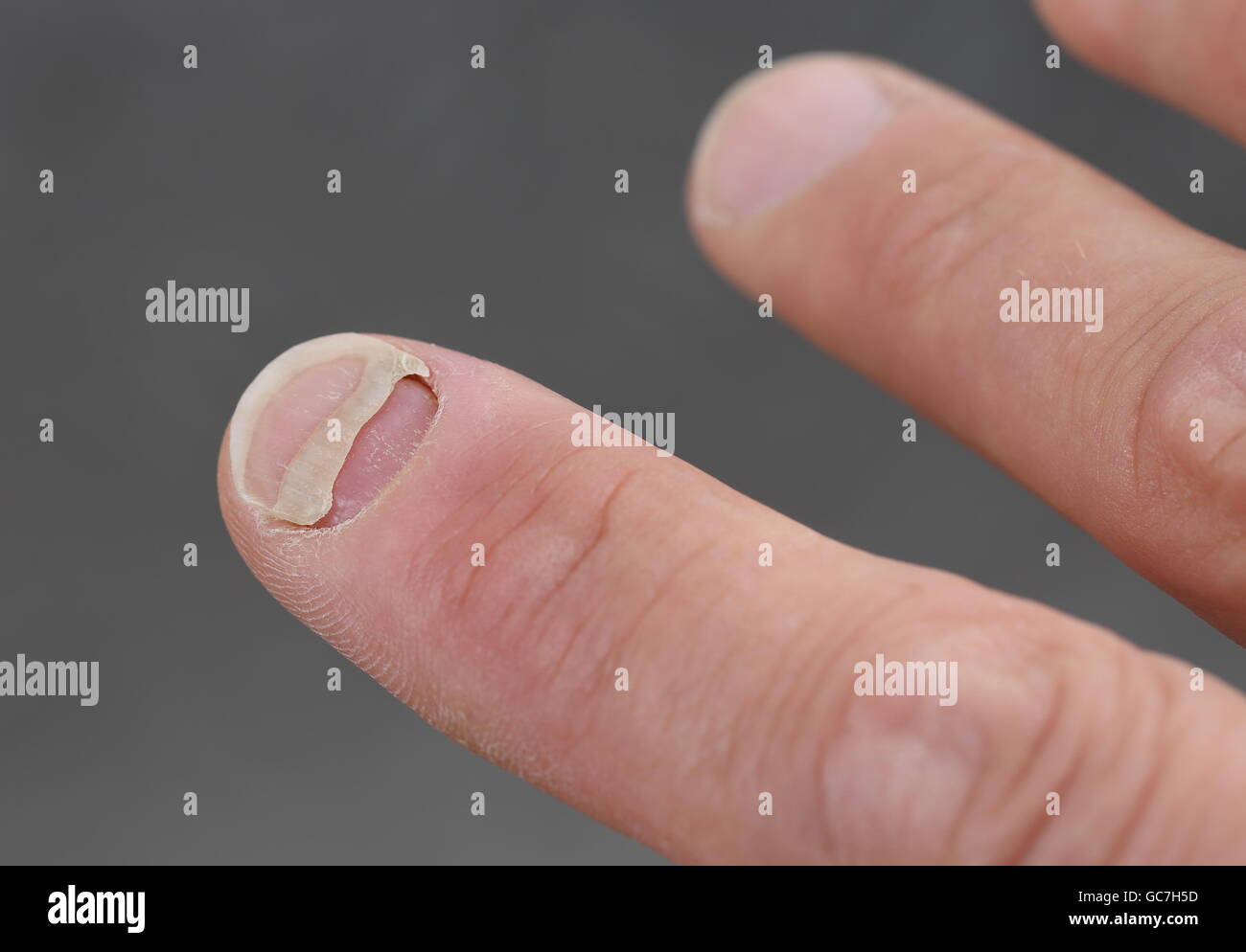 A Patient with nail detachment Stock Photo