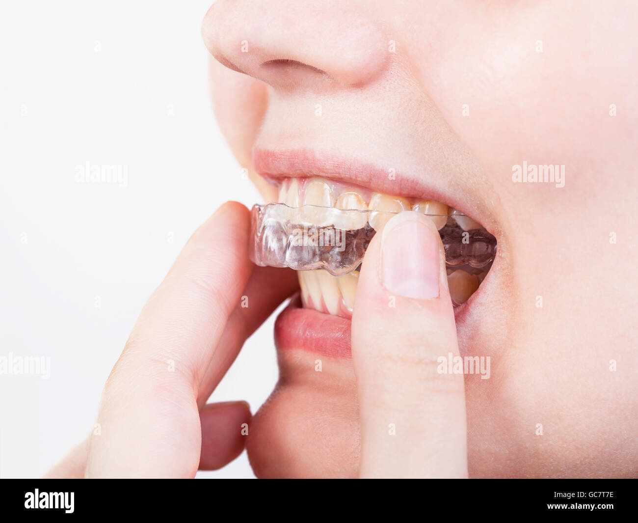 girl fixes transparent aligner for dental treatment Stock Photo