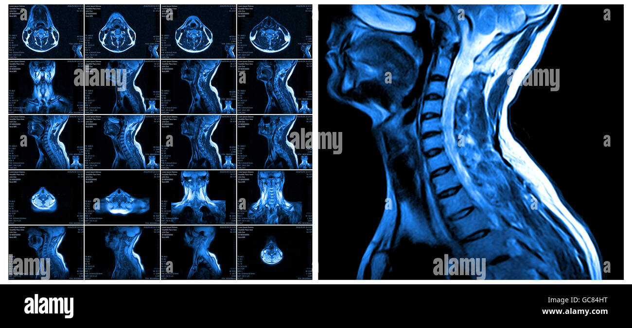 Magnetic resonance imaging of the cervical spine. Stock Photo