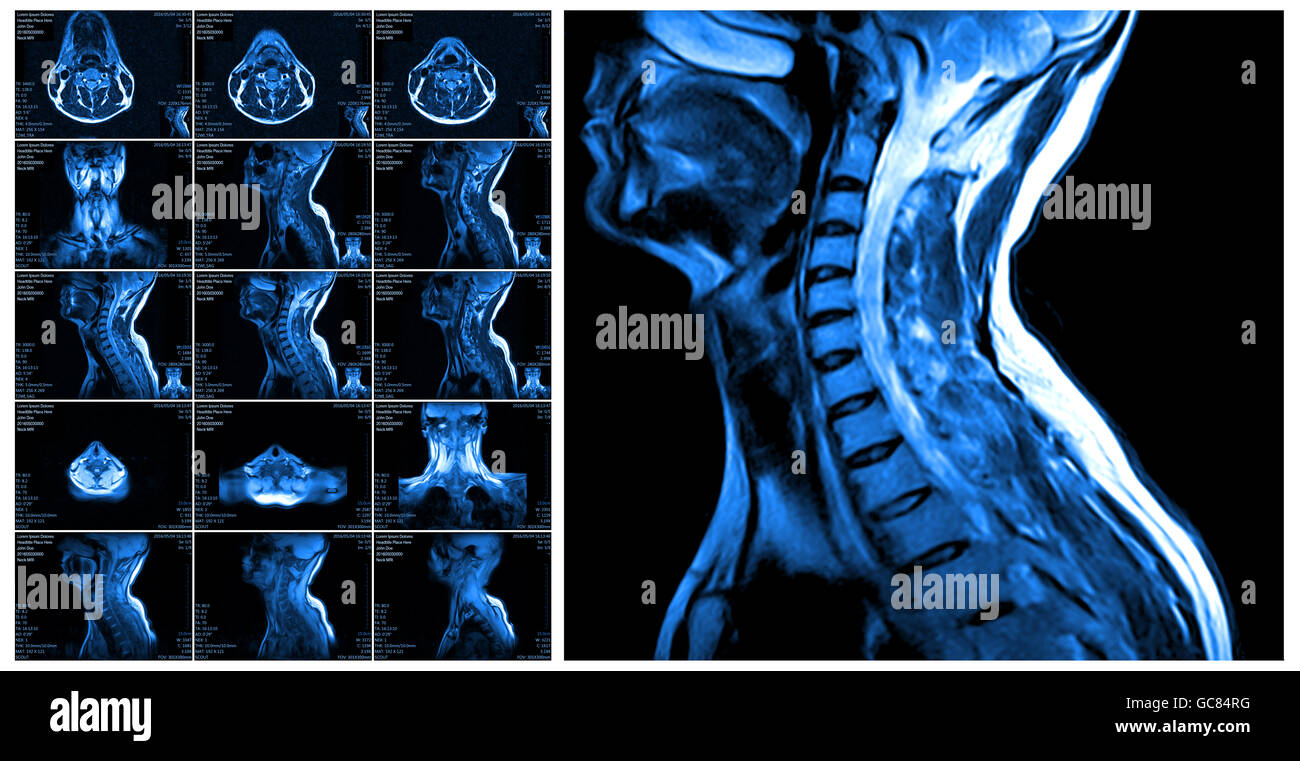 Magnetic resonance imaging of the cervical spine. Stock Photo