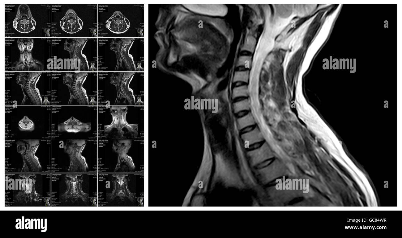 Cervical artery Black and White Stock Photos & Images - Alamy