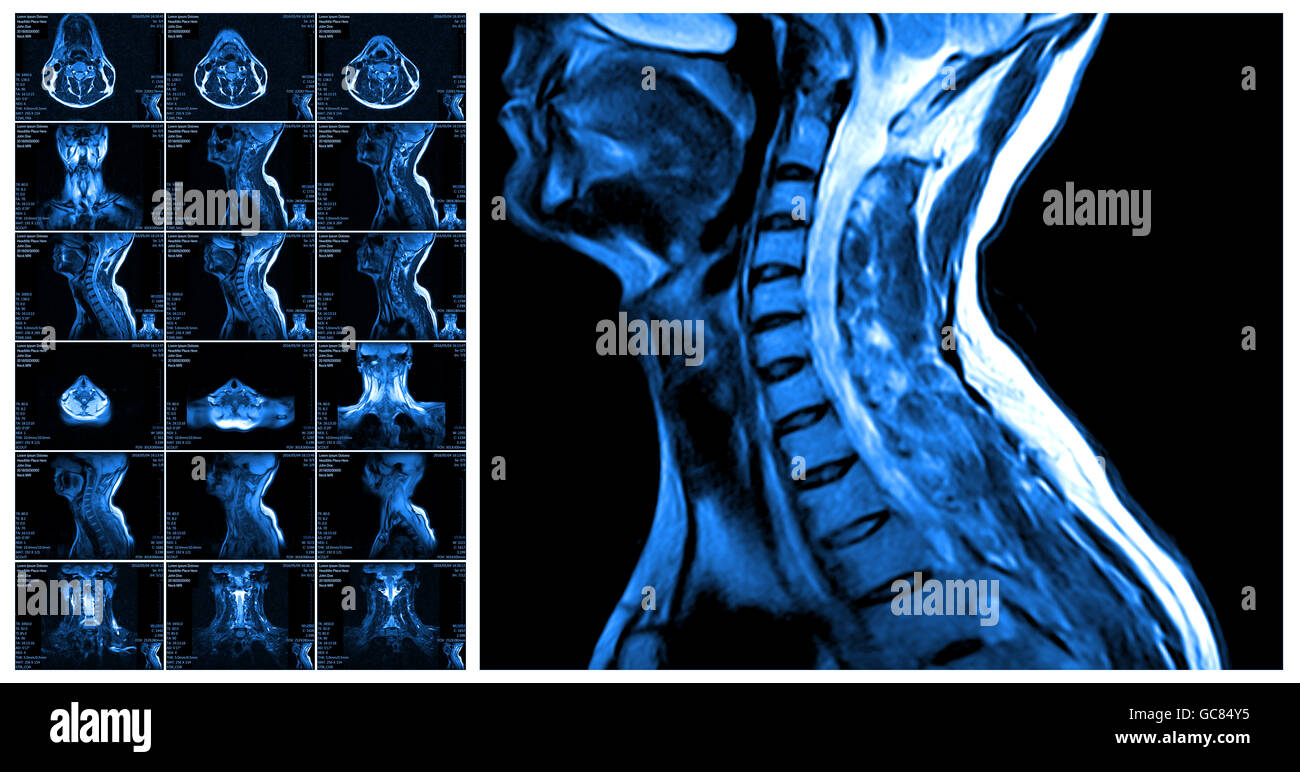 Human head neck mri hi-res stock photography and images - Alamy