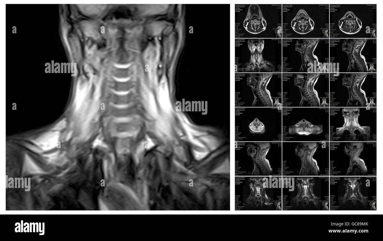 Magnetic resonance imaging of the cervical spine. Stock Photo
