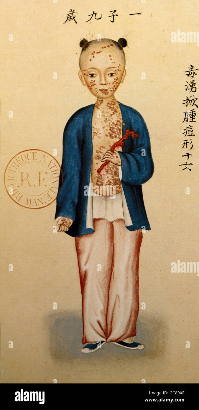 Smallpox china hires stock photography and images Alamy