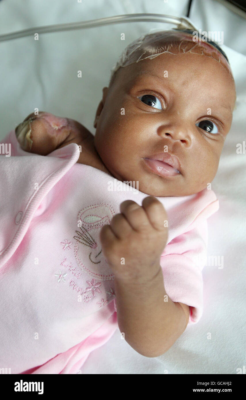 Landina Seignon, a 3-month old victim of the Haiti earthquake, has successfully undergone a life-saving operation at Great Ormond Street Hospital, London, after she was brought to the UK by the charity 'Facing the World'. She is the first Haitian child to be brought to the UK. Stock Photo