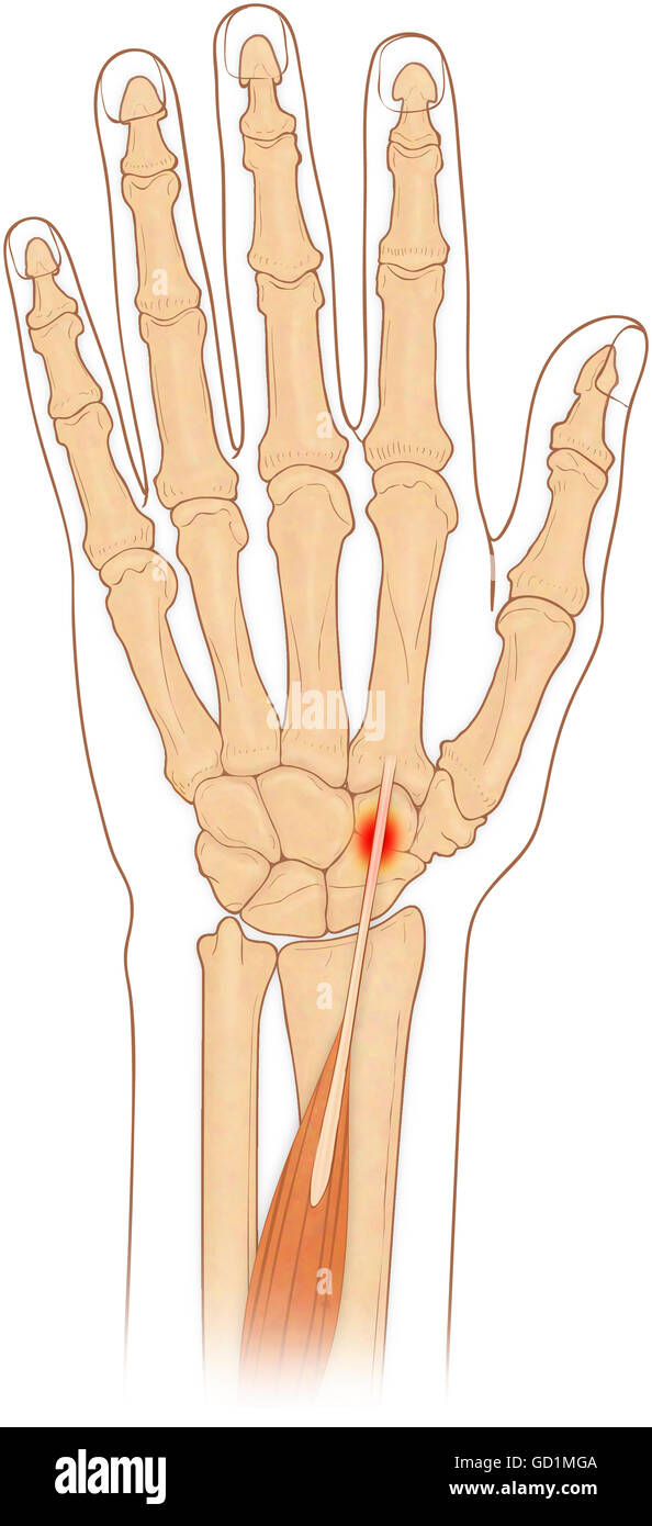 Anterior view of hand bones with inflammed extensor carpi radialis longus muscle Stock Photo