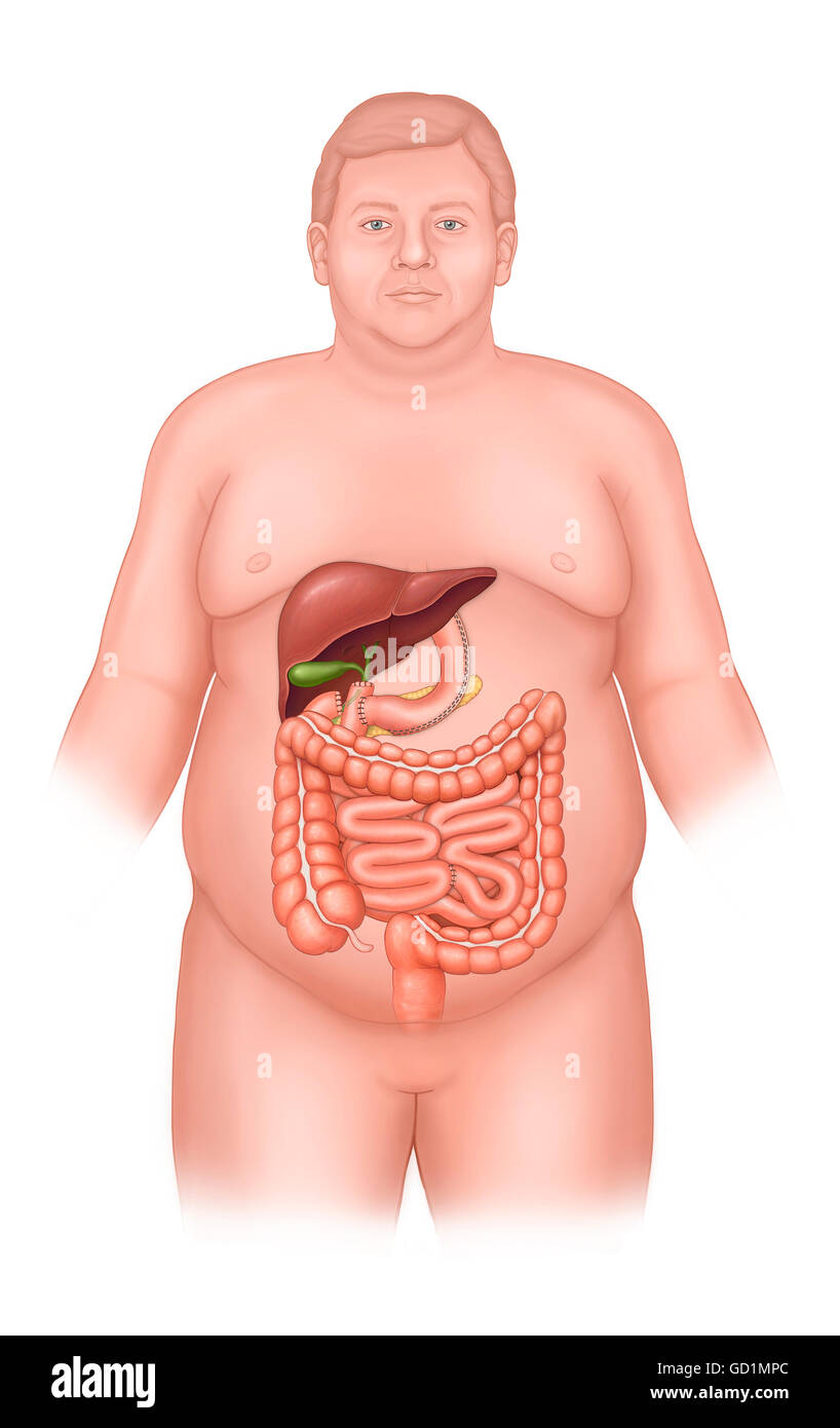 Post bilio pancreatic diversion surgery and abdominal organs Stock Photo