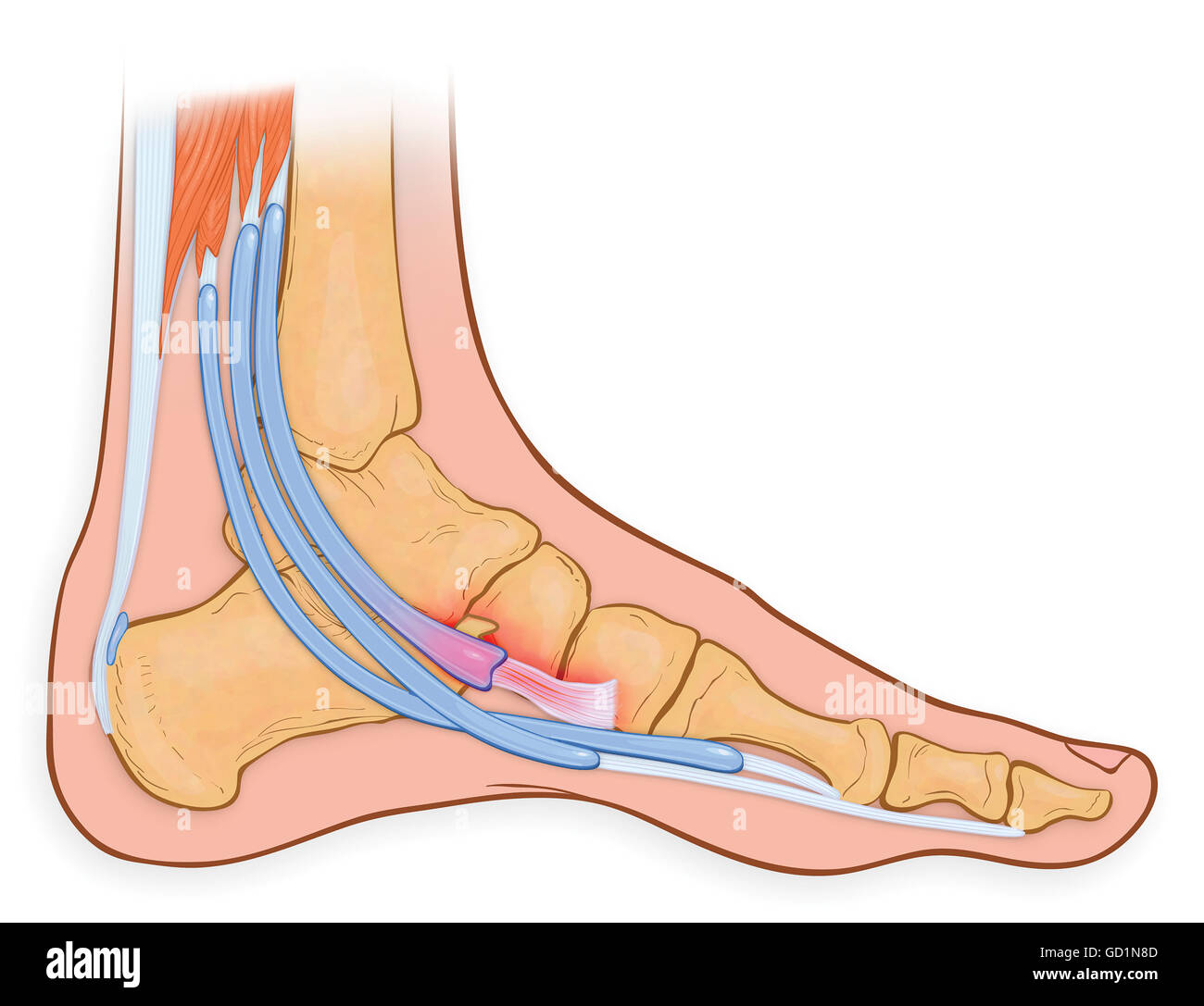 Medial view of the foot showing inflamed and frayed tibialis posterior tendon Stock Photo
