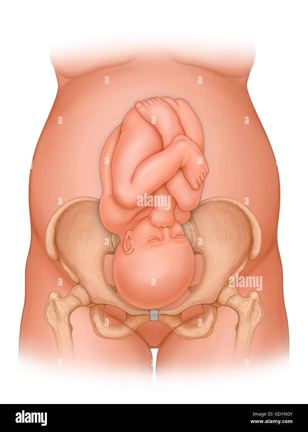 Front view of a woman nine months pregnant  (baby phantomed within) ready for delivery, with baby in improper position for delivery Stock Photo