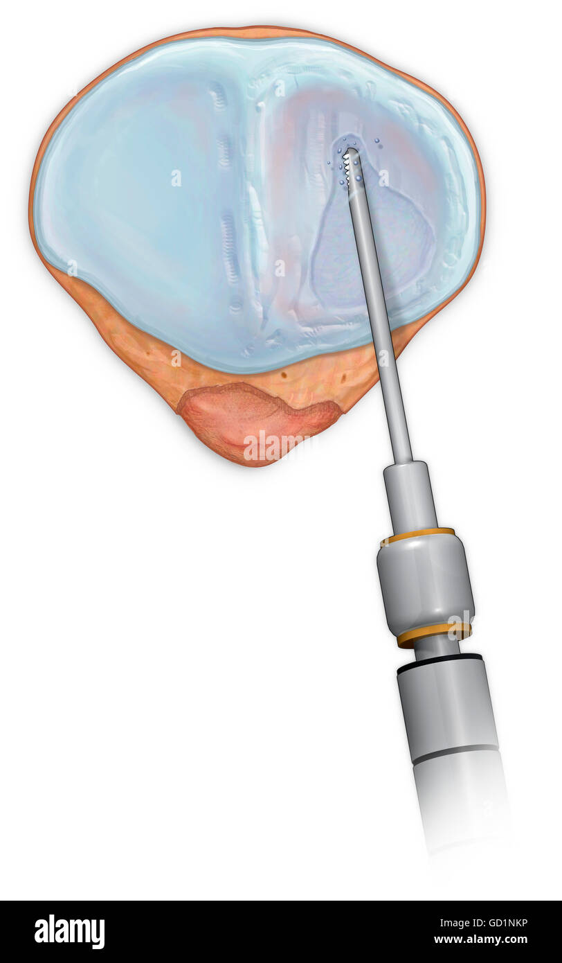 Posterior view patellar surface showing injured cartilage being cleaned up with a shaver Stock Photo