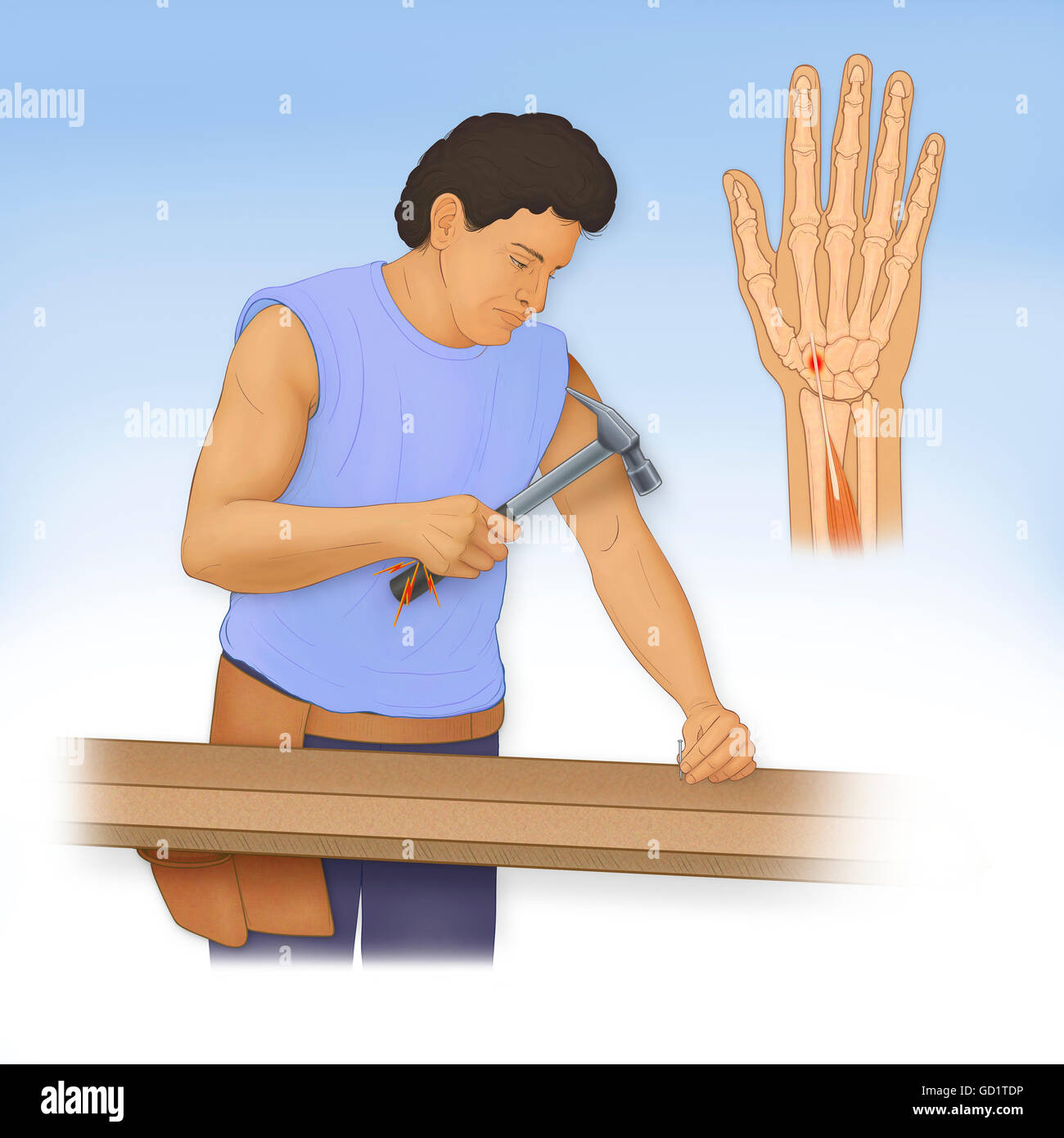 Illustration of the FlexorCarpi Radialis Tendinitis, caused by repetitive trauma such as prolonged use of a heavy hammer Stock Photo