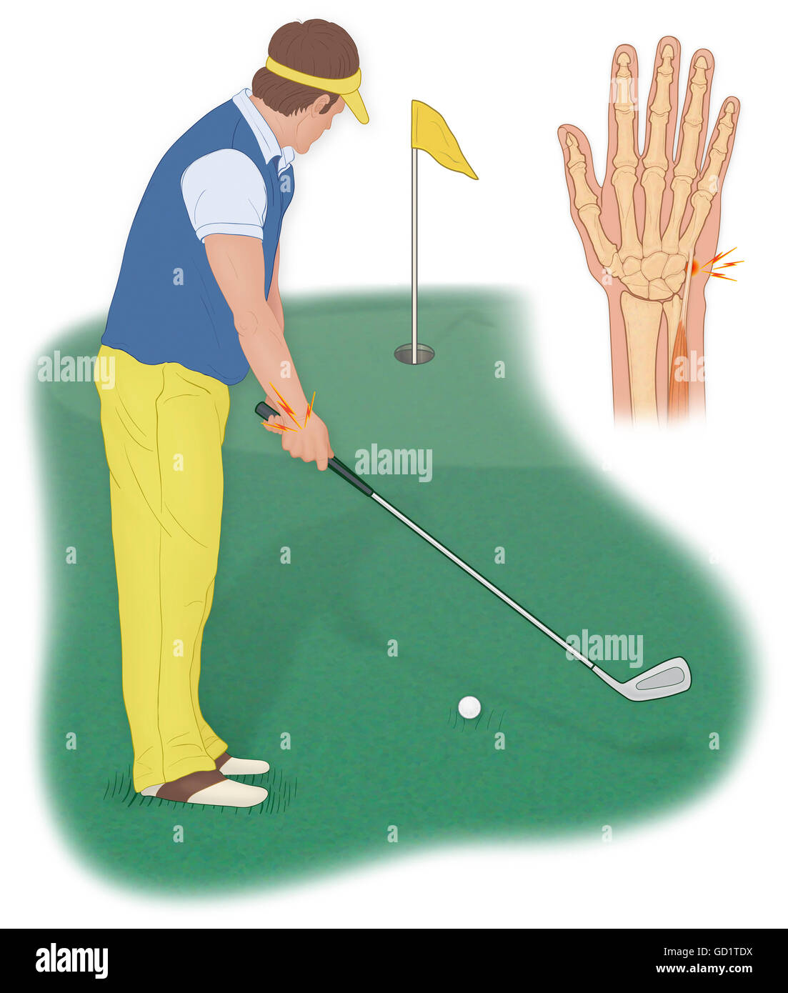 A golfer can develop an acute extensor carpi ulnaris tendinitis injury from improper grip of a golf club and over use Stock Photo