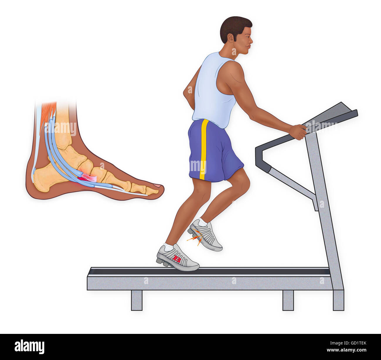ankles-hurt-from-running-on-treadmill-cheap-sale-emergencydentistry